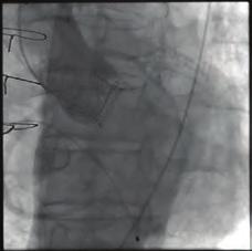 8 cm, max/ mean gradyent: 8/8 mm Hg, hafif derecede paravalvüler mıtral yetmezlik, aortik mekanik protez kapakta max/mean gradyent: 44/8 mm Hg, trıkuspit biyoprotez kapakta max/mean gradyent: 0/ mm