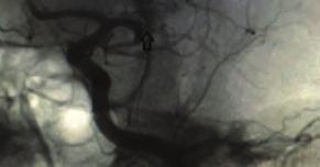 In this case, we presented a patient who had an acute cerebrovascular event after a successful TAVI procedure and treated with mechanical thrombectomy.