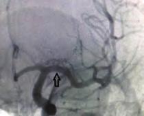 During procedure, pre-dilatation with 3 mm balloon was performed and then 7 mm Symetis valve was implanted to the aortic position.