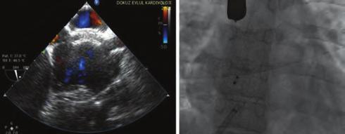 Transtorasik ekokardiyografide(tte) ejeksiyon fraksiyonu %60, orta triküspit yetersizliği, pulmoner arter basıncı 45 mm Hg ölçüldü. Qp/Qs:.85 ölçüldü.