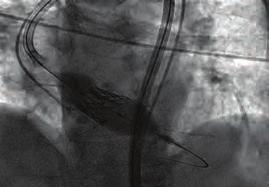 Girişimsel kardiyoloji / Kapak ve yapısal kalp hastalığı Girişimsel kardiyoloji / Kapak ve yapısal kalp hastalığı OS-43 Triple stenting due to immediate stent recoils in a patient with left main