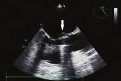 Hastanın yapılan TÖE sinde mitral-aortik intervalvüler fibroza psödoanevrizması ve paravalvuler ileri derecede aort yetersizliği orta derece mitral yetersizlik görüldü.