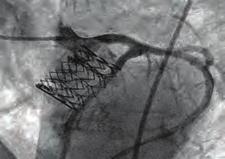 coronary occlusion and aortic rupture are two rare but life-threatening complications, and because of their poor prognosis. There are cases of successful LMCA stenting following TAVI.