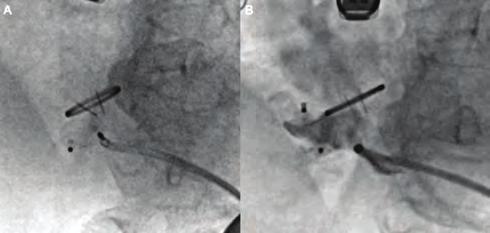 Girişimsel kardiyoloji / Kapak ve yapısal kalp hastalığı Girişimsel kardiyoloji / Kapak ve yapısal kalp hastalığı Clinical presentation of LVOT pseudoaneurysm varies from asymptomatic to catastrophic