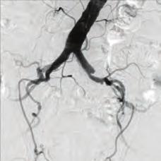 The early treatment of the pseudoaneurysm is of import to reduce the risk of complications and to decrease the morbidity and mortality.