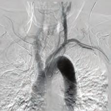 of multiple aortic root surgeries. Coil embolization and the AVP are the suitable percutaneous treatment modalities.