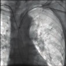 Additionally, the AVP embolization with the transapical approach provides shorter and more linear access to the LVOT than the transseptal approach that makes easy the procedure. Şekil. İliac DSA.