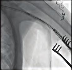 (B) The procedure was terminated with showing completely blood flow cessation from left to right ventricle. Şekil 3. ESHEAT yerleştirilmesi. Şekil 4. Kapağın ilerletilmesi. Figure.