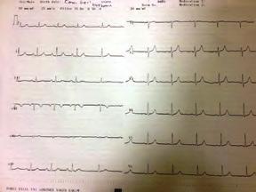 Vaka: Opere prostat kanseri, tiroid nodülü, tip diabetesmellitus, hipertansiyon öyküleri olan 65 yaşında erkek hasta yıllardır olan ve son birkaç gündür özellikle efor yaparken artan göğüs ağrıları