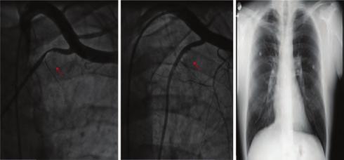 Girişimsel kardiyoloji / Koroner Konjenital kalp hastalıkları proximal intermediate, anterior descending, circumflex and middle right coronary arteries (Video ).
