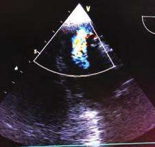 LIMA proximal plaque structure was followed and when the left arm was raised the hyperabduction, LIMA proximal severe flow interruption was occurred (Fig.-a/Video ).