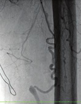 OS-57 Yüzeyel femoral arter total oklüzyonu olan hastada transkollateral retrograd periferik anjioplasti tekniği