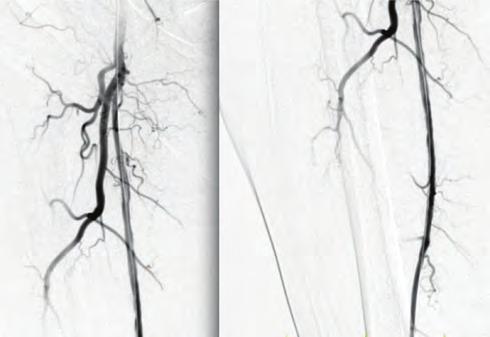 Girişimsel kardiyoloji / Karotis ve periferik vasküler Aritmi / Elektrofizyoloji / Pacemaker / CRT-ICD Şekil 3. Trombektomi setindeki trombüs. Şekil 9. Ayrı seansta açılan sağ YFA nın görüntüsü.