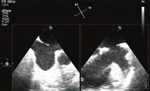 Konjenital kalp hastalıkları Girişimsel kardiyoloji / Karotis ve periferik vasküler as partial anomalous pulmonary venous return.