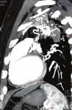 Immediately after this, transcatheter ASD closure with a -mm ASD occluder device was carried out under TEE guidance. The procedure was completed successfully without any complications.