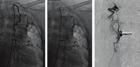 dyspnea and recurrent attacks of severe hemoptysis for years. He had a past medical history of tuberculosis. Physical examination revealed a /6 continuous murmur along the left sternal border.