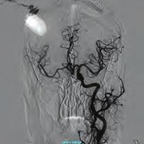 İntra-arteriel nitrat sonrası spazmın geçtiği ve oluşan sonucun oldukça tatmin edici olduğu izlendi işlem komplikasyonsuz bitirildi (Şekil 8).