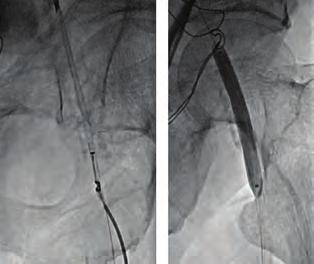 Hasta son 6 aydır sol bacakta Rutherford sınıf 3 klaudikasyosu olması üzerine DSA yapıldı. Sol ana femoral ve yüzeyel femoral arterlerde ileri derecede kalsifik darlıklar saptandı.