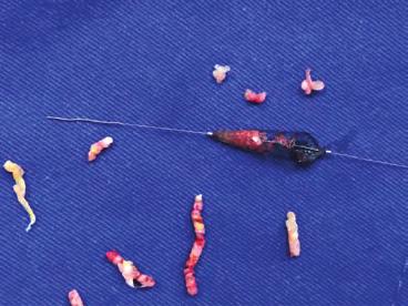 Sol ana femoral artere yapılan aterektomi ve ilaçlı balon ugulaması. Şekil 6. İşlem sonrası ana femoral arterin görüntüsü.