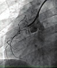 Kalp konseyi neticesinde operasyona uygun bulunmayıp hastaya anjioplasti kararı alındı. RCA ya IMA guiding kateteri ile oturuldu,.0x5 mm balonla dilate edildi.