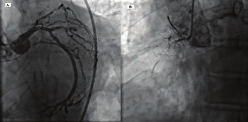 cm ventricular septal rupture (VSR) at the mid interventricular septum (Figure 4A, B).