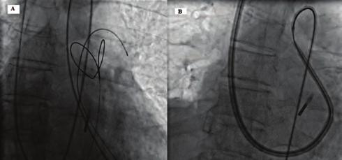 The VSR crossed with the right Judkins catheter.