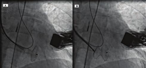 It was caught with a snare and was removed from the right jugular vein (Figure 5A). Finally, arteriovenous loop was formed.