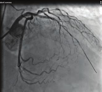 7 mm atrial septal defect device was choosen for closing the VSR.