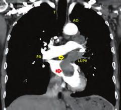 Kardiyak görüntüleme / Ekokardiyografi Diğer Figure 3. Transesophageal echocardiography.