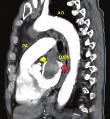 LA: left atrium, LV: left ventricle, PA: pulmonary artery. Figure 4. Thorocal computed tomography horizontal view.