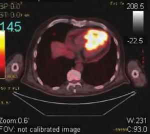 Ao: aorta, PA: pulmonary artery. Figure. Anterior ST segment elevation on ECG. Figure 5. Thorocal computed tomography coronal view.  Ao: aorta, PA: pulmonary artery, T: trachea. Figure 6.