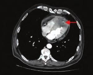 Diğer OS-73 Cardiac metastasis mimicking acute anterior myocardial infarction Anar Mammadli, Türkan Seda Tan, Veysel Kutay Vurgun, Ayşe İrem Demirtola, Çağdaş Özdöl, İrem Dinçer, Tamer Sayın