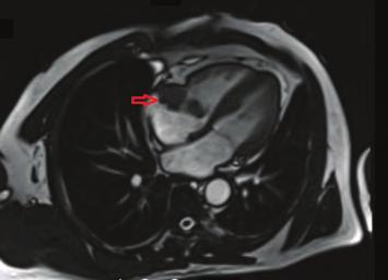 Kontrol kardiyak MR da sağ atriyumda kitlede imajında nüks izlendi.