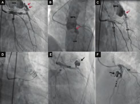 Girişimsel kardiyoloji / Koroner Girişimsel kardiyoloji / Koroner OPS-00 Treatment of a fistula between coronary and pulmonary arteries by simultaneous use of two microcatheters for antegrade coil