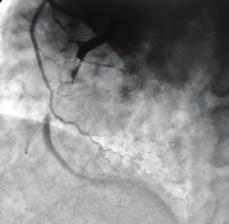 old female patient presented due to stable angina pectoristhat was present for ten months.