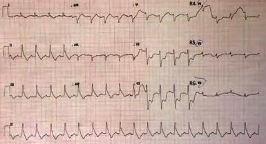 Girişimsel kardiyoloji / Koroner Girişimsel kardiyoloji / Koroner Şekil. Arrest sonrası EKG. Figure. Admission ECG shows an acute inferior ventricular myocardial infarction. Şekil 3.