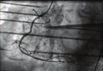 Timely performed percutaneous coronary intervention is the treatment of choice for acute myocardial infarction in very elderly.