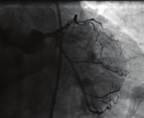 load, a trans venous pacemaker implanted and a coronary angiography was performed (Figure 3). At the same session, a drug eluting stent was implanted for proximal right coronary artery occlusion.