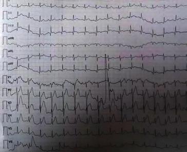 Girişimsel kardiyoloji / Koroner Girişimsel kardiyoloji / Koroner RCA, LAD ve CX koroner arterlerde 3 damar koroner vazospazmı görülen (Şekil ), sonrasında hastaya uygulanan tedaviler ile koroner