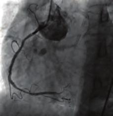 Tekrarlayan predilatasyonlar yapıldı ancak akım sağlanamadı (Şekil ). Hastaya İABP takılarak kalp damar cerrahisi bölümüne devir edildi.