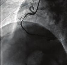 Girişimsel kardiyoloji / Koroner Girişimsel kardiyoloji / Koroner OPS-009 RCA ve pulmoner arter arasında seyreden koroner arter fistülün başarılı perkütan coil embolizasyonu ile kapatılması Halit