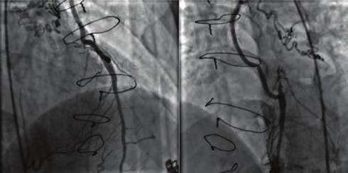 Girişimsel kardiyoloji / Koroner Girişimsel kardiyoloji / Koroner OPS-03 Subacute anterior myocardial infarction due to an embolic thrombus in a patient with mechanical valve prosthesis Şekil.