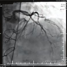 Nabız 77 atım/ dk, kan basıncı 5/75 mm Hg, so: %97 olarak ölçüldü. EKG sinde bigemine yapan monomrofik ventriküler extrasistolleri (PVC) mevcuttu.