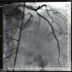 RVOT anteroseptal bölgeden kaynaklı başarılı VES ablasyonu yapıldı. Ardından sol Judkins kateter ile sol koroner anjiografi planlandı. Fakat sol koroner sisteme oturulumadı.