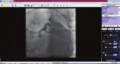 Timely recognition of the dissection and construction of a proper treatment plan based on the type of the dissection and the clinical status of the patient is needed to overcome this potentially