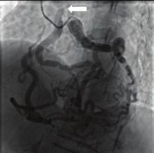 LSD is a rarely encountered complication but can be see in complex lesions such as ostial, bifurcation and LMCA lesions.