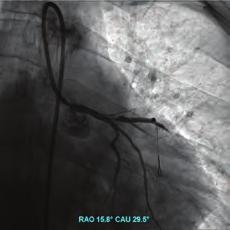 The patient was immediately taken to the hemodynamics laboratory and angiography performed. Angiography revealed subtotal occlusion in the left main coronary artery with extreme thrombi (Figure ).