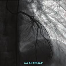 0x5 mm balloon was inflated. After balloon inflation, 3.0x8 mm drug eluting stent was implanted into the from the left main to anterior desending coronary artery (LAD). And than with 4.