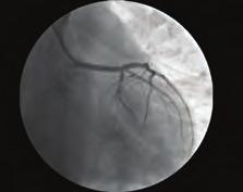 In this report, we describe the case of a male patient, in whom acute ST-segment elevation and myocardial infarction developed immediately after the taking oral pheniramine.