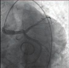 The total area of the lesion was crossed with guidewire (Figure ). Then.0x5 mm balloon was inflated and provided flow (Figure 3, 4). After inflating the balloon, a 3.